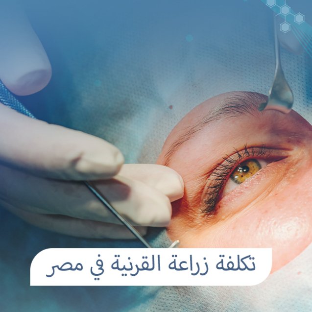 تكلفة زراعة القرنية في مصر
